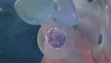 Ferric Carboxymaltose Injectafer Medication Patient Information video thumbnail