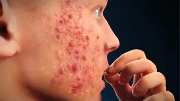 Isotretinoin Absorica Accutane Medication Patient Information video thumbnail