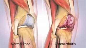 Sodium Hyaluronate Hylasto One Medication Patient Information video thumbnail