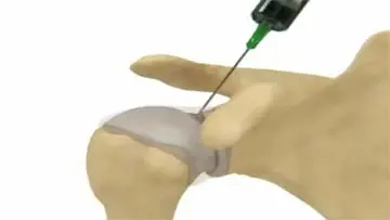 Sodium Hyaluronate Hylasto One Medication Patient Information video thumbnail